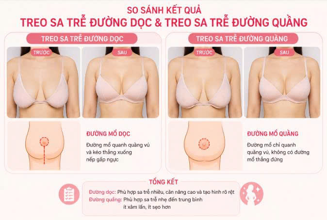 treo-sa-tre-duong-doc-va-duong-quang-khac-nhau-nhu-the-nao-tim-hieu-chi-tiet-de-chon-dung-phuong-phap-phu-hop