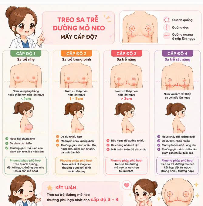 treo-sa-tre-duong-mo-neo-cap-do-may-thi-phu-hop-tim-hieu-chi-tiet-cac-muc-do-sa-tre-truoc-khi-thuc-hien
