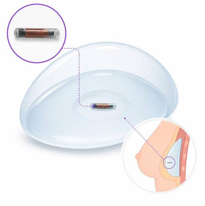 nang-nguc-nano-chip-co-phat-hien-duoc-khong-phan-tich-chi-tiet-cac-thong-tin-ban-can-biet-de-an-tam-lam-dep