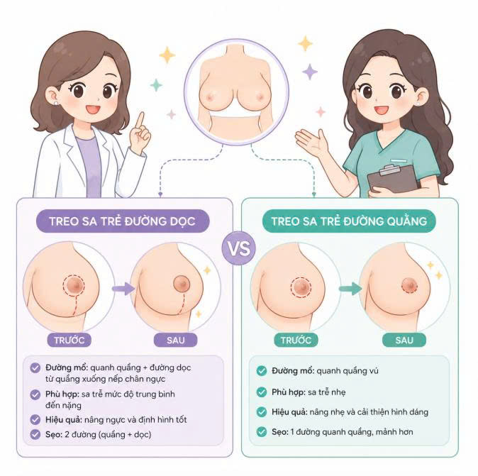 treo-sa-tre-duong-doc-khac-gi-duong-quang-goc-nhin-chi-tiet-ve-duong-mo-dang-nguc-va-kha-nang-tao-hinh-cua-tung-phuong-phap
